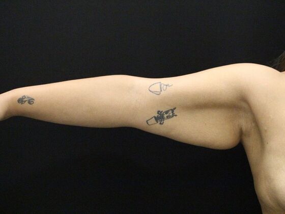 Arm Lift & Reduction: Case 11 - Before