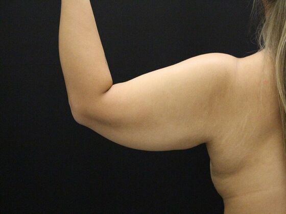 Arm Lift & Reduction: Case 11 - Before