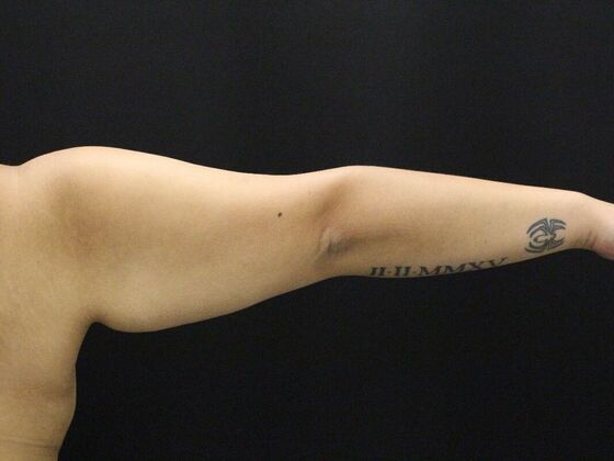 Arm Lift & Reduction: Case 11 - Before