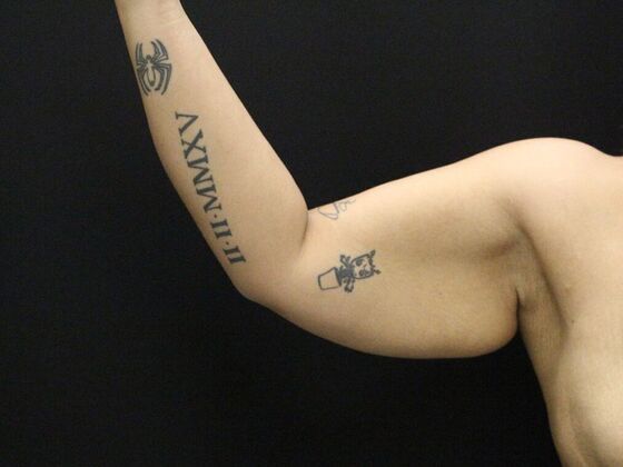 Arm Lift & Reduction: Case 11 - Before