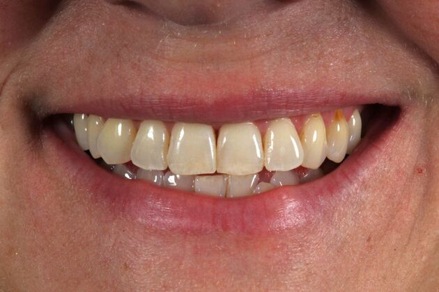 Full Mouth Rehabilitation: Lindsey - Before