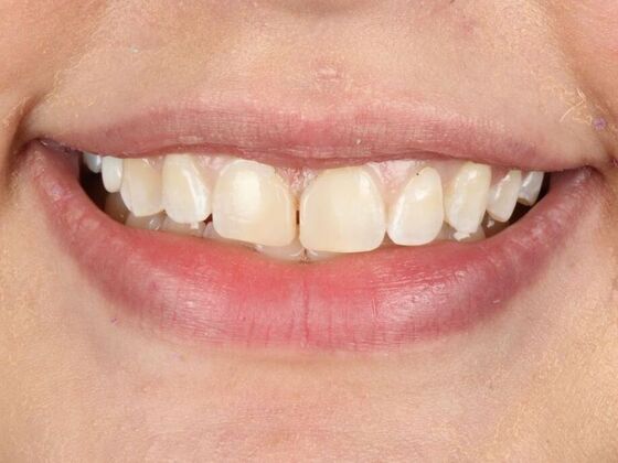 Porcelain Veneers: Sandy - Before