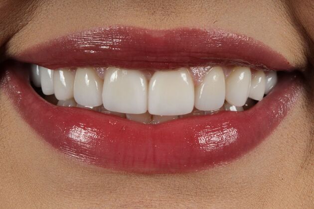 Porcelain Veneers: Sandy - After