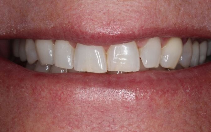 Porcelain Veneers: Michelle. - Before