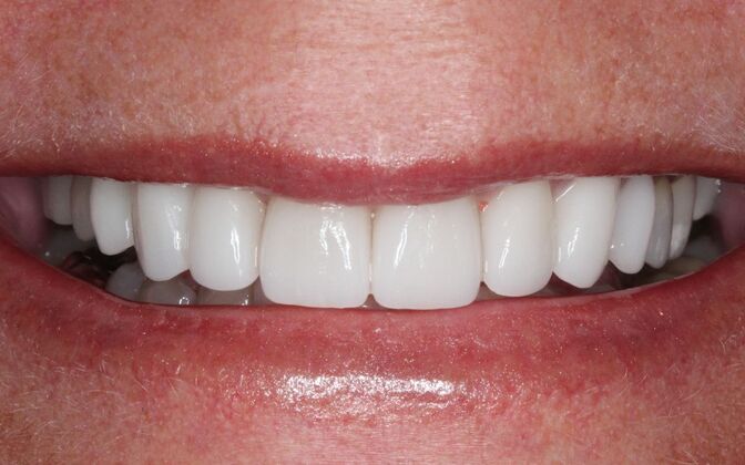 Porcelain Veneers: Michelle. - After