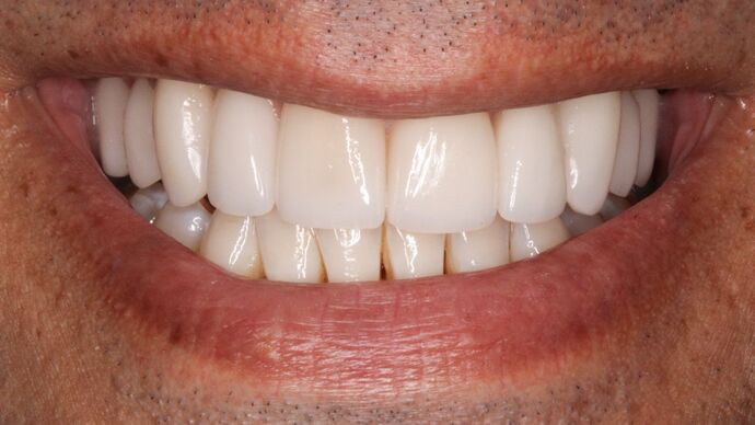 Porcelain Veneers: Greg - After