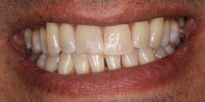 Porcelain Veneers: Greg - Before