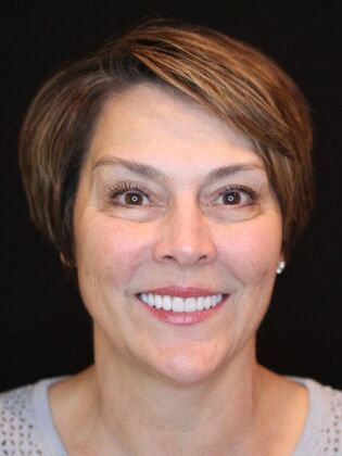 Porcelain Veneers Julia - After