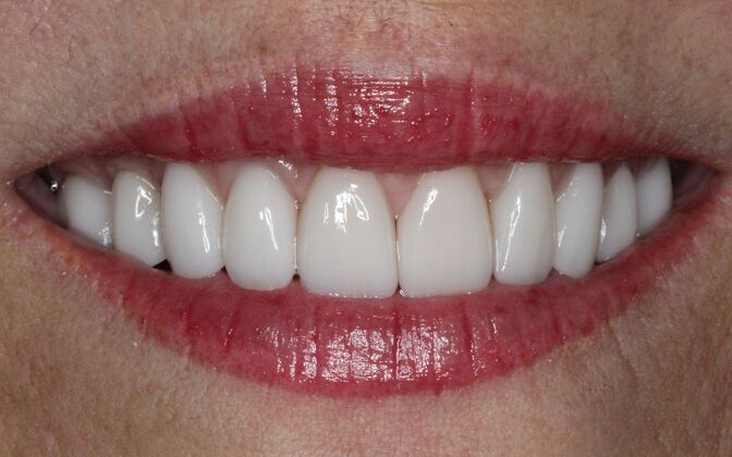 Porcelain Veneers: Julia - After