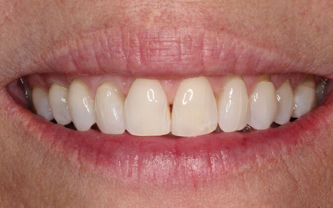 Porcelain Veneers: Julia - Before