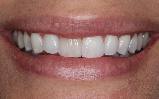 Porcelain Veneers: Alison - Before