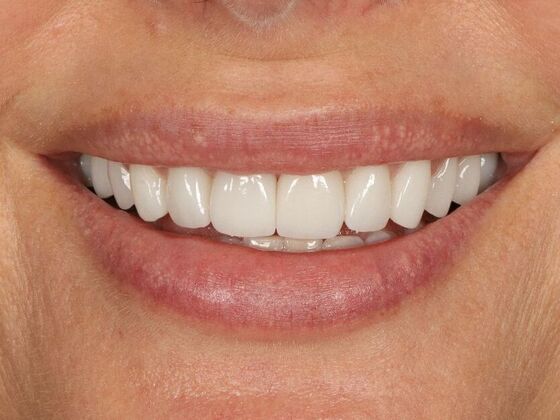 Porcelain Veneers: Alison - After