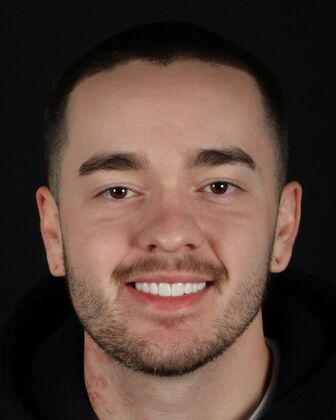 Porcelain Veneers Johnny - After