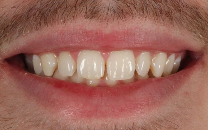 Porcelain Veneers: Johnny - Before