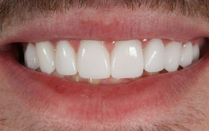 Porcelain Veneers: Johnny - After