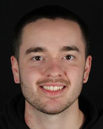 Porcelain Veneers Johnny - Before