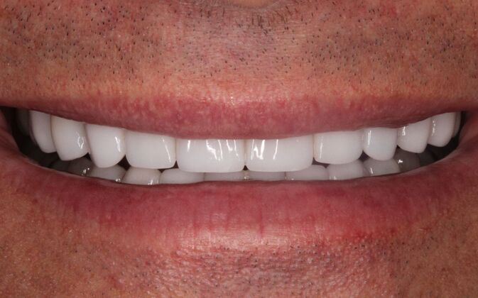 Porcelain Veneers: Rick - After