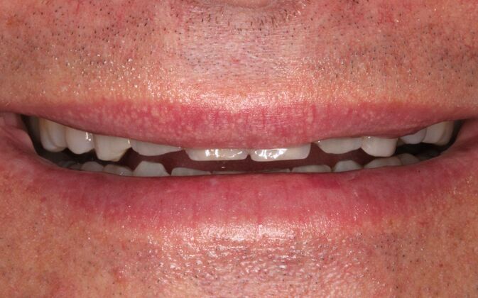 Porcelain Veneers: Rick - Before