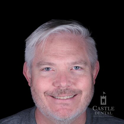 Porcelain Veneers Cases