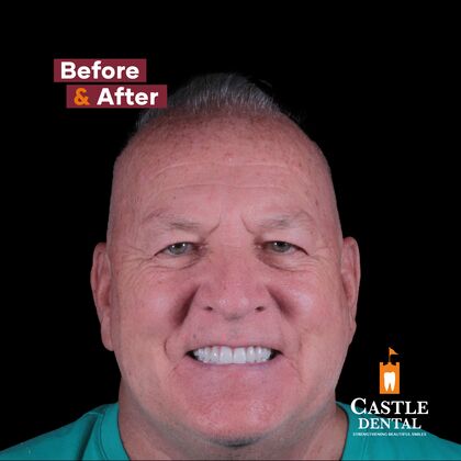 Full Arch Implants Cases