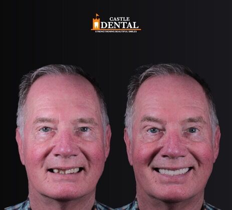 Removable Dentures Case