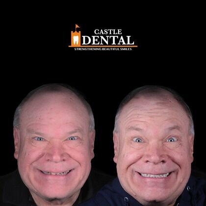 Zirconia Crowns Cases