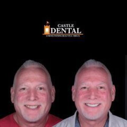 Zirconia Crowns Case 9