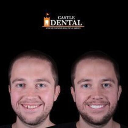 Zirconia Crowns Case 13