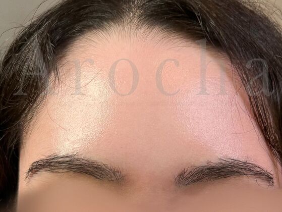 Eyebrow Transplantation: Case 4 - After