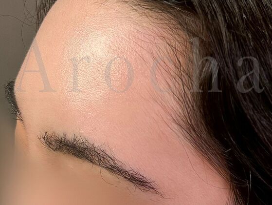 Eyebrow Transplantation: Case 4 - After