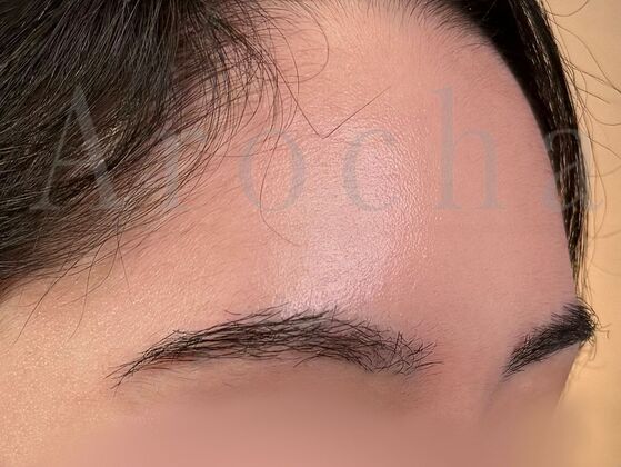 Eyebrow Transplantation: Case 4 - After