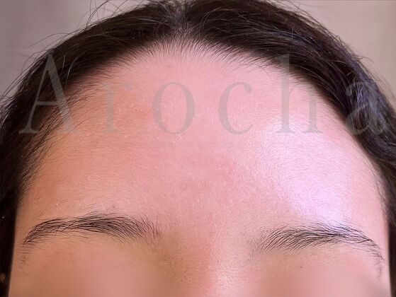 Eyebrow Transplantation: Case 4 - Before