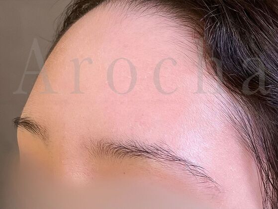 Eyebrow Transplantation: Case 4 - Before