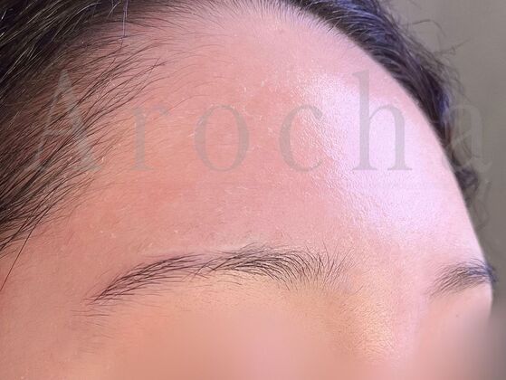 Eyebrow Transplantation: Case 4 - Before