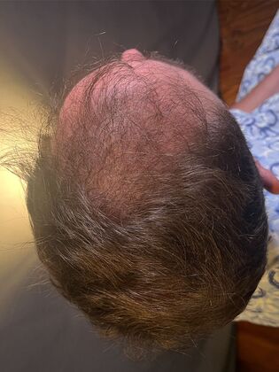 FUE Hair Restoration: Case 37 - Before