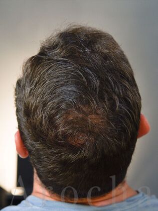 FUE Hair Restoration: Case 37 - After