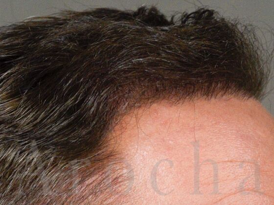 FUE Hair Restoration: Case 37 - After