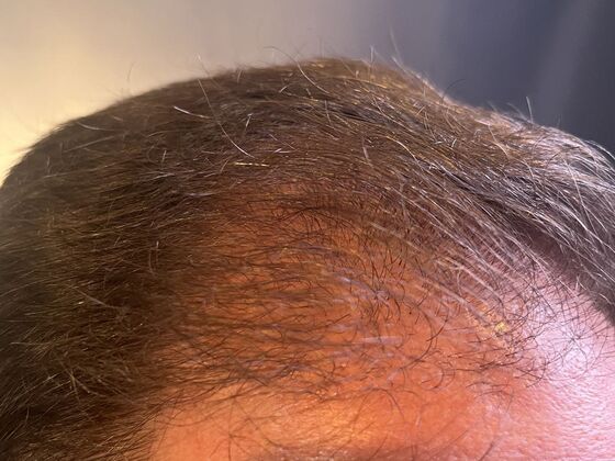 FUE Hair Restoration: Case 37 - Before