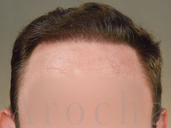 FUE Hair Restoration: Case 37 - After