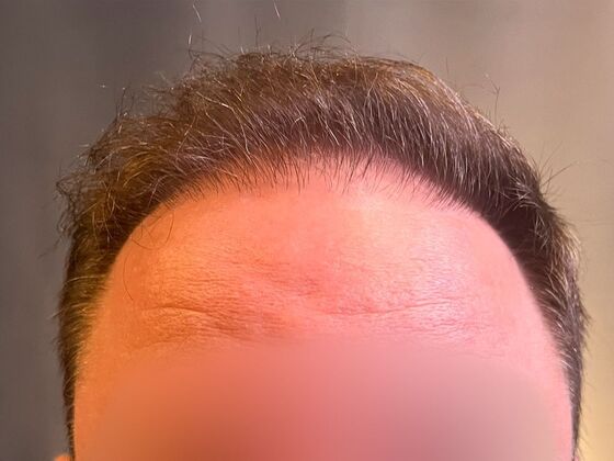 FUE Hair Restoration: Case 37 - Before