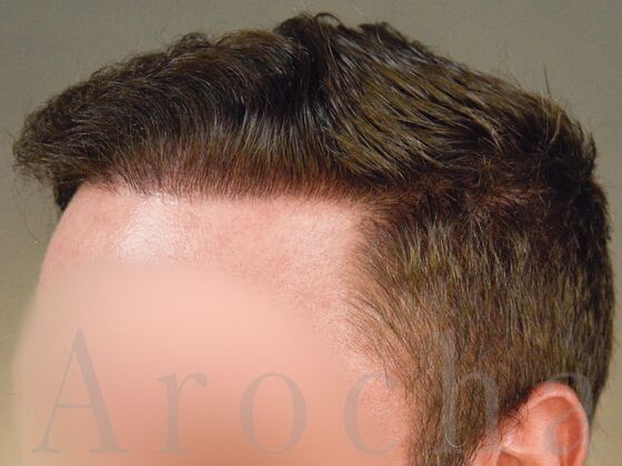 FUE Hair Restoration: Case 37 - Before