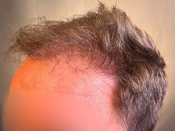 FUE Hair Restoration: Case 37 - Before