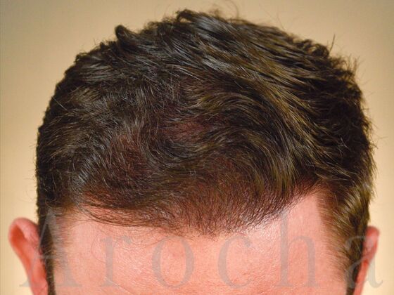 FUE Hair Restoration: Case 37 - After