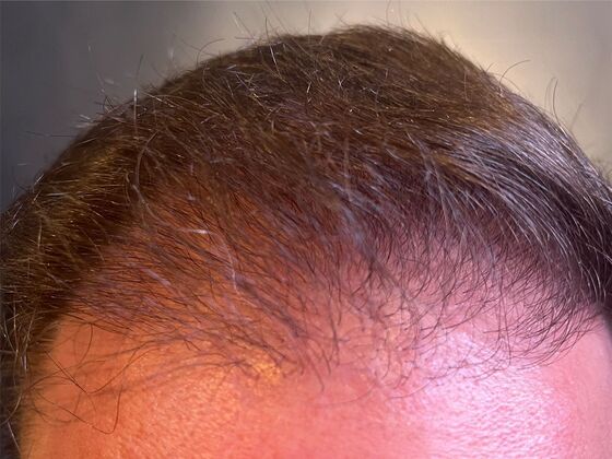 FUE Hair Restoration: Case 37 - Before