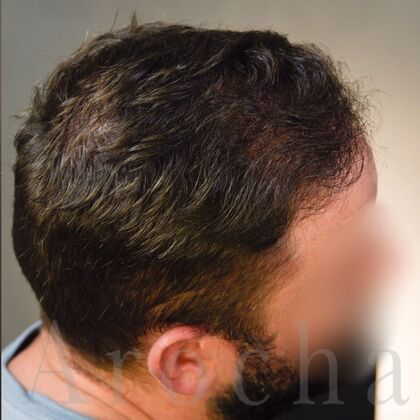 FUE Hair Restoration: Case 37 - After