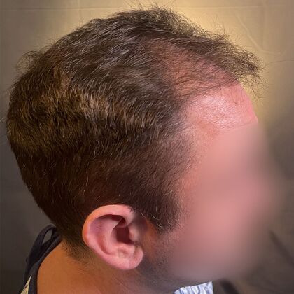 FUE Hair Restoration: Case 37 - Before