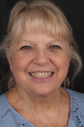 Full Mouth Restoration Teresa Connor- Full Mouth Restoration- Zirconia Crowns - Before