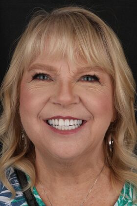 Full Mouth Restoration Teresa Connor- Full Mouth Restoration- Zirconia Crowns - After