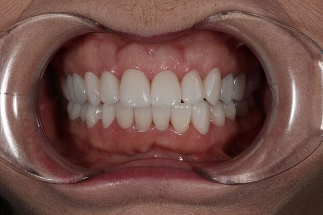 Full Mouth Restoration: Teresa Connor- Full Mouth Restoration- Zirconia Crowns - After