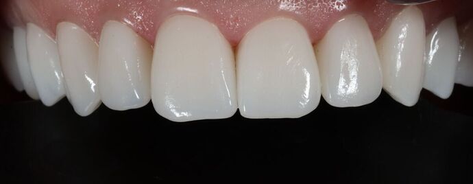 Full Mouth Restoration: Teresa Connor- Full Mouth Restoration- Zirconia Crowns - After